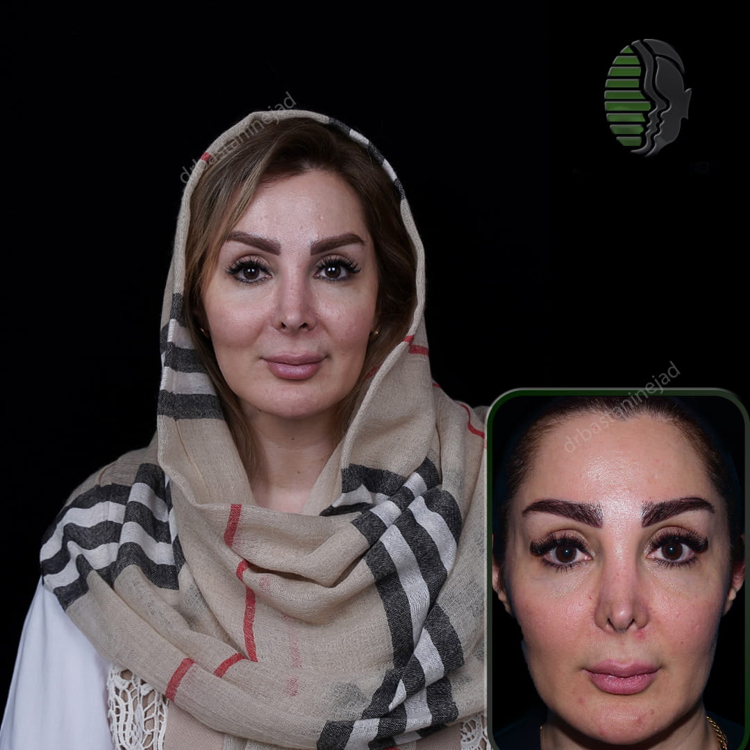 عکس قبل و بعد از جراحی بینی ترمیمی