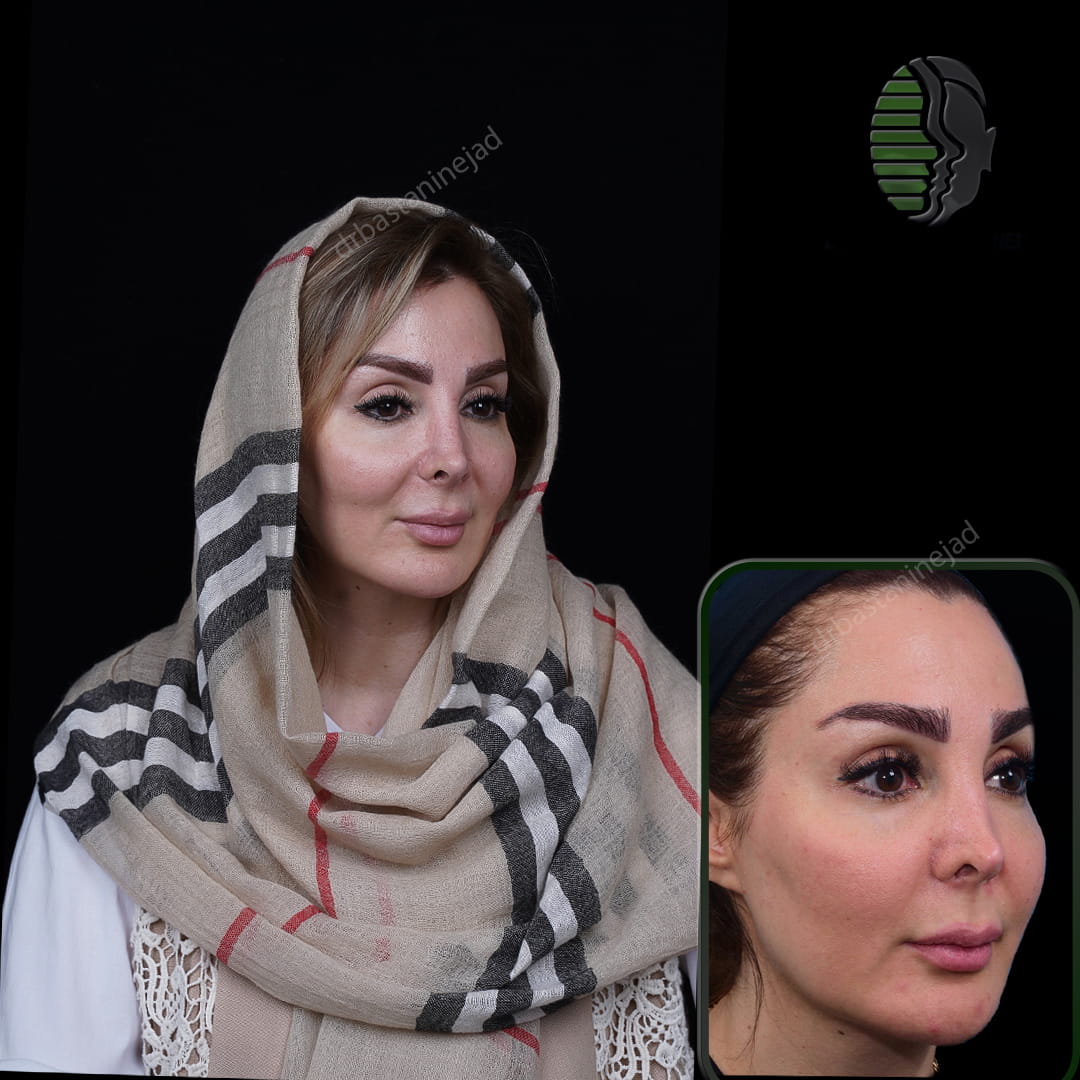 تصویر سه رخ بعد از عمل بینی ترمیمی