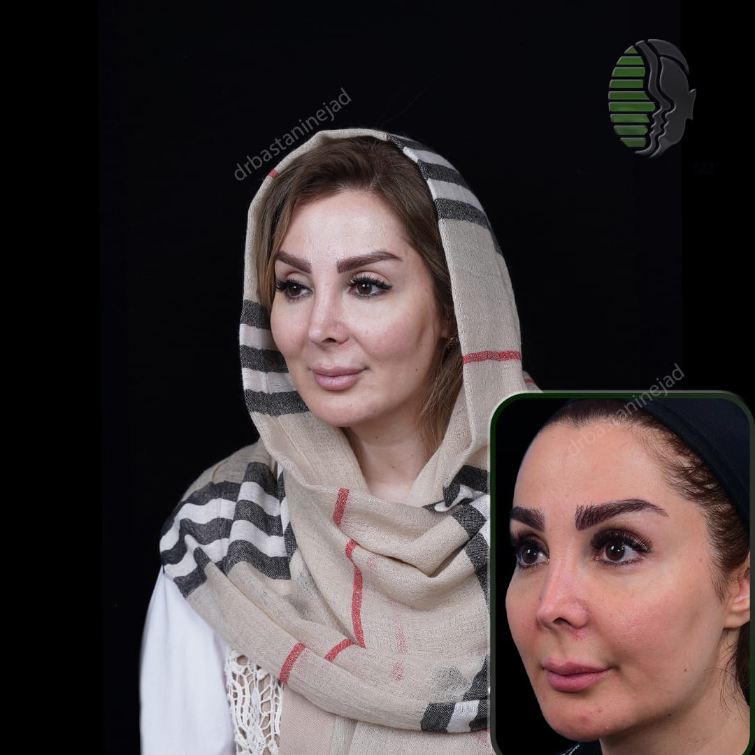 تصویر سه رخ بعد از عمل بینی ترمیمی