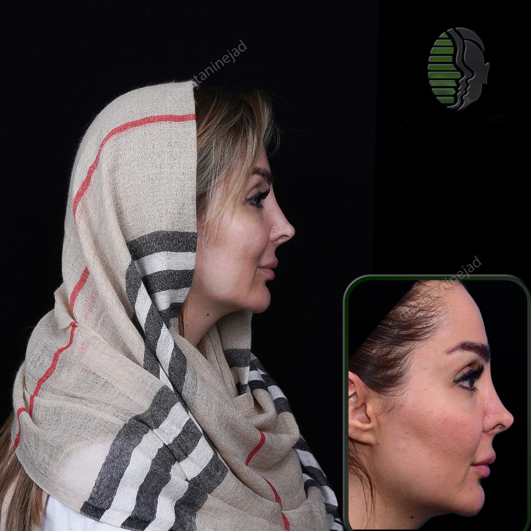 تصویر نیم رخ بعد از عمل بینی ترمیمی
