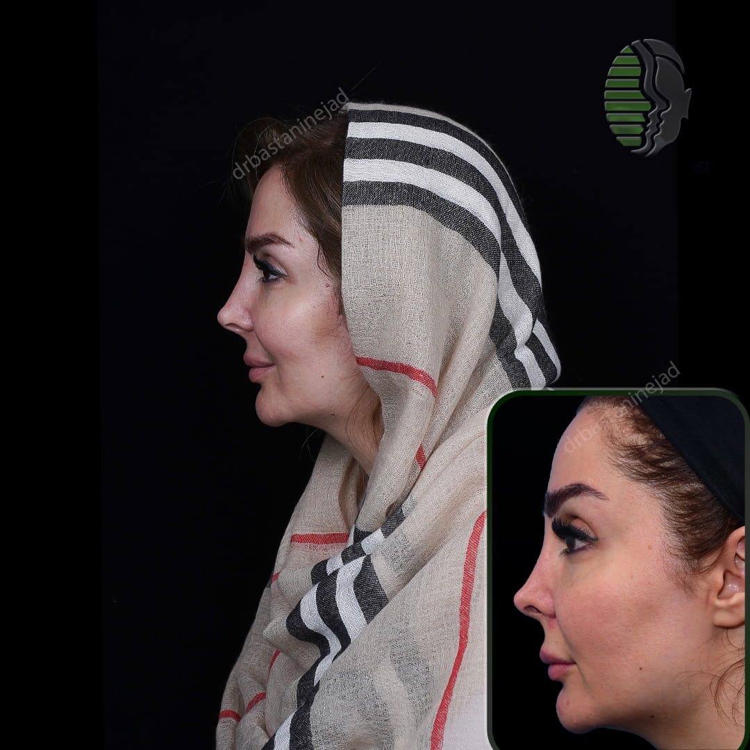تصویر نیم رخ بعد از عمل بینی ترمیمی