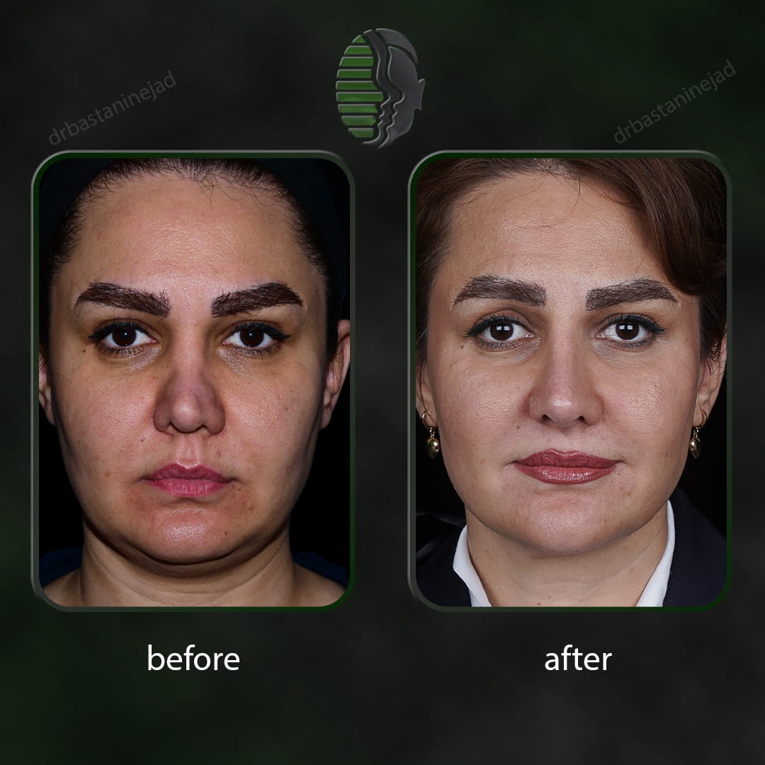 تصویر رو به رو قبل و بعد از جراحی بینی ترمیمی پس از 1 سال