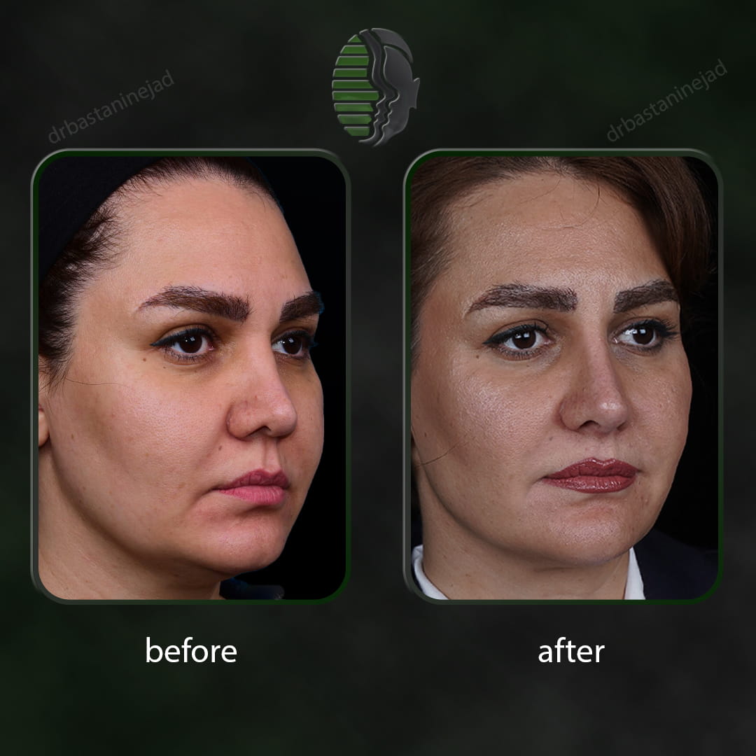 تصویر سه رخ قبل و بعد از جراحی بینی ترمیمی پس از 1 سال - دکتر باستانی نژاد