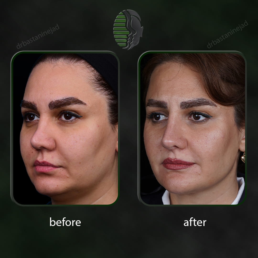 تصویر قبل و بعد از جراحی بینی ترمیمی پس از 1 سال