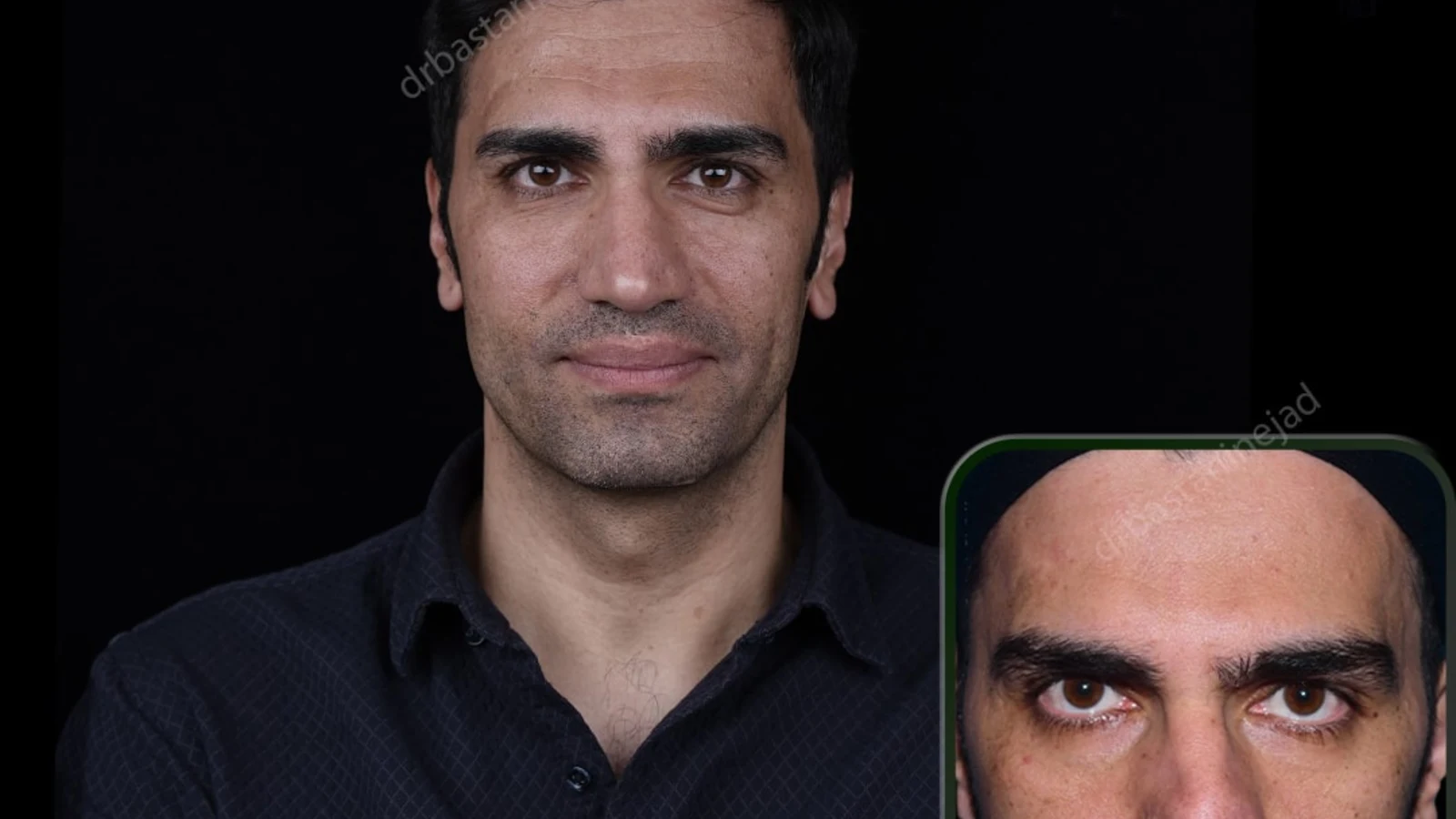 ترس از بیهوشی کامل در جراحی بینی؛ واقعیت‌های مبتنی بر شواهد